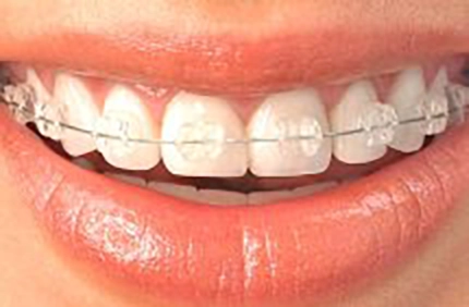 Ceramic braces