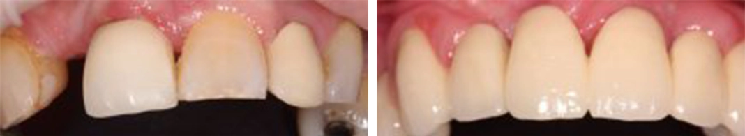 Fillings and crowns