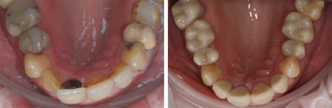 Fillings and crowns
