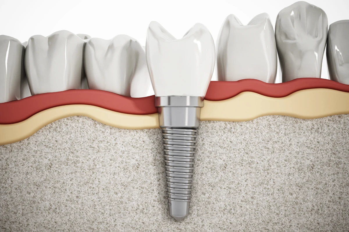 Tips To Care For Your Dental Implants