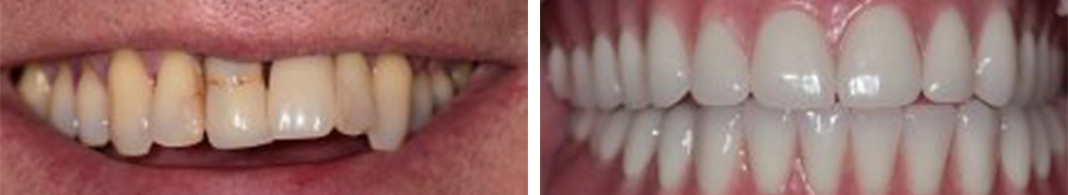 Implant supported denture