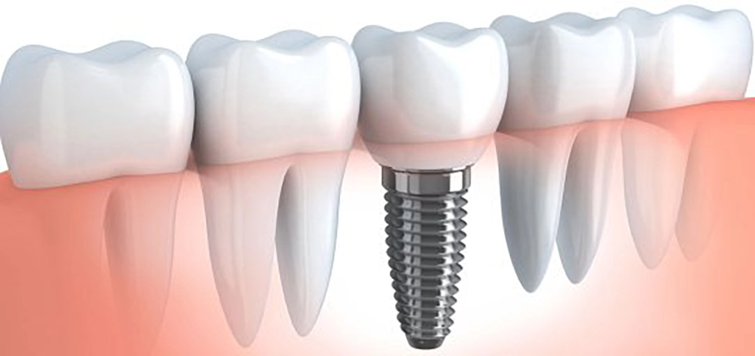 Implant supported crown