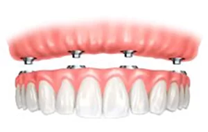 Implant supported denture