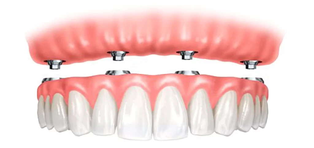 Implant supported denture