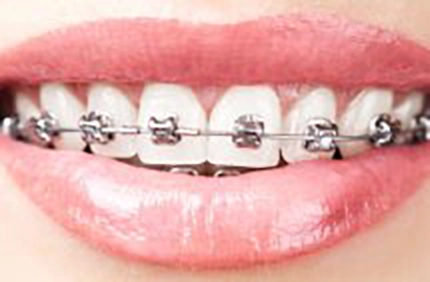 Metal braces