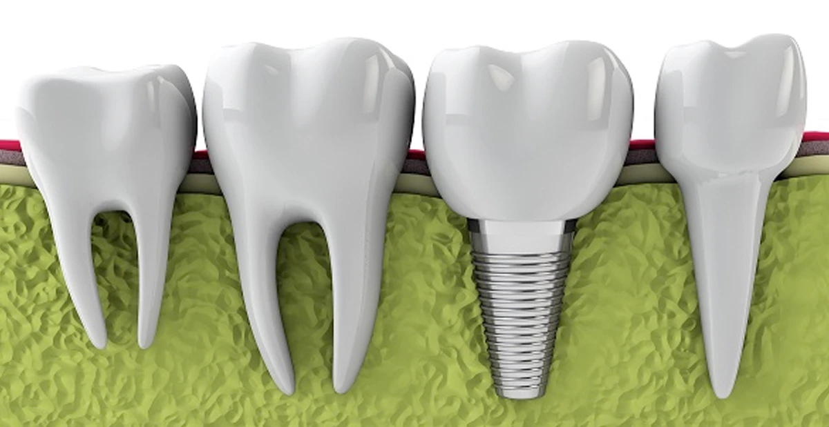 Dental implants and stem cells: what's the deal?