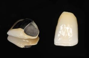 Porcelain bonded to metal crowns