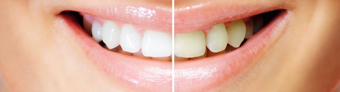 Teeth Whitening